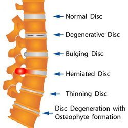 Slipped disc or herniated disc or disc prolapse pain cure