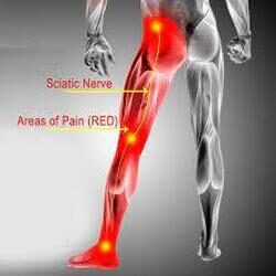 Sciatica Hip Pain cure